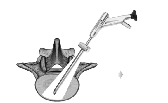 脊柱内窥镜手术器械 Surgical Instruments for Endoscopic Surgery