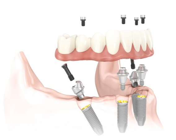 种植体配套用基台及螺丝Abutments and Screws for Implants
