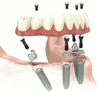 牙科种植体NOBELSPEEDY Dental Implant System